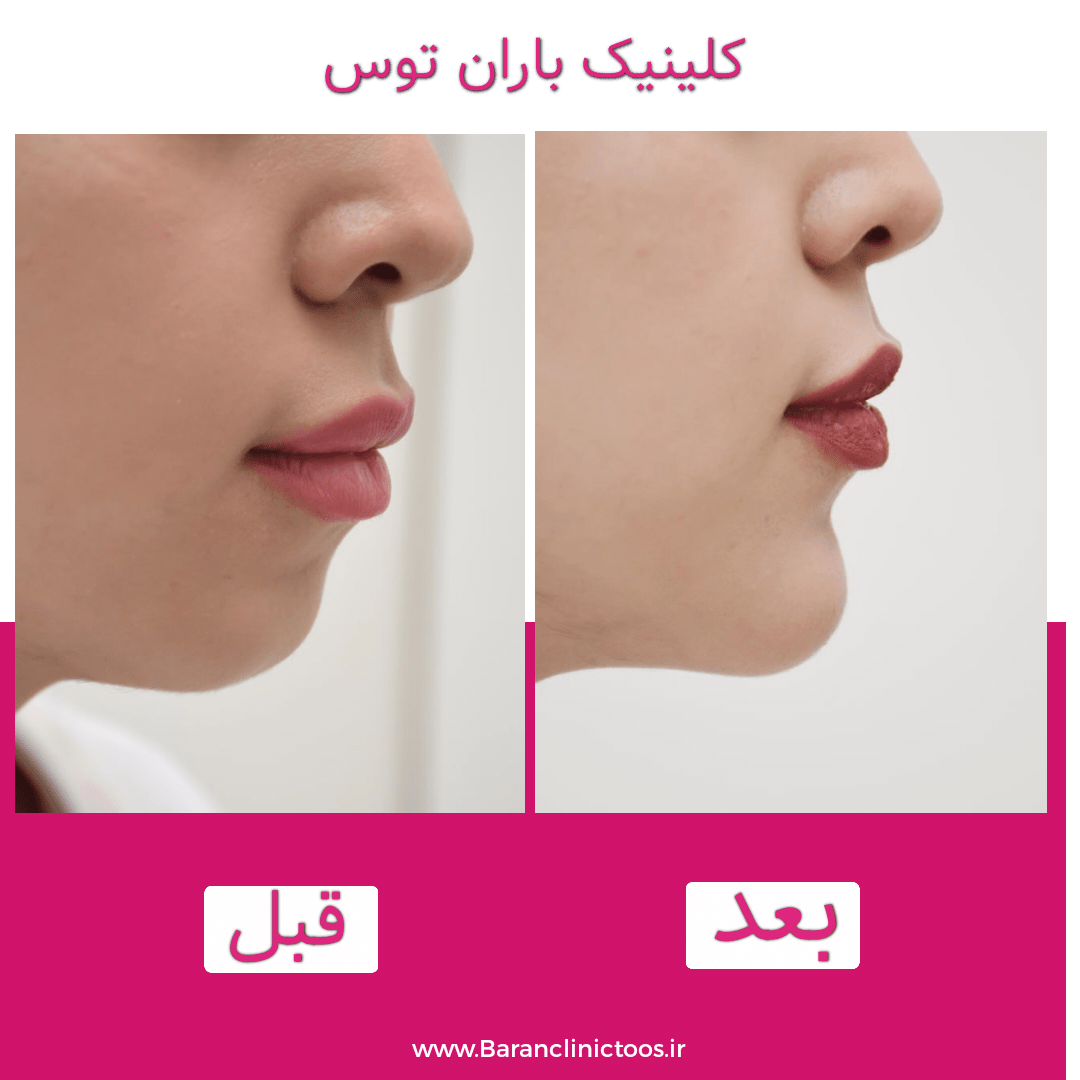 قبل و بعد فیلر لب